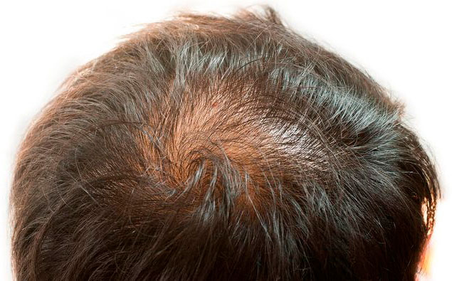 Propecia Generika zur Behandlung von Haarausfall