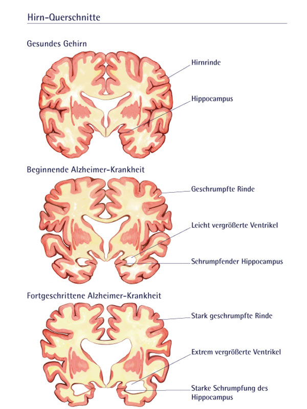 Alzheimer-Krankheit